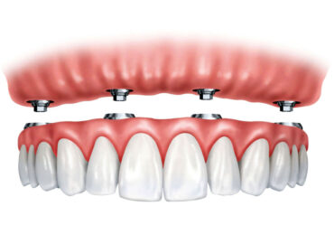 Implantes de carga inmediata o "dientes  en un solo día"
