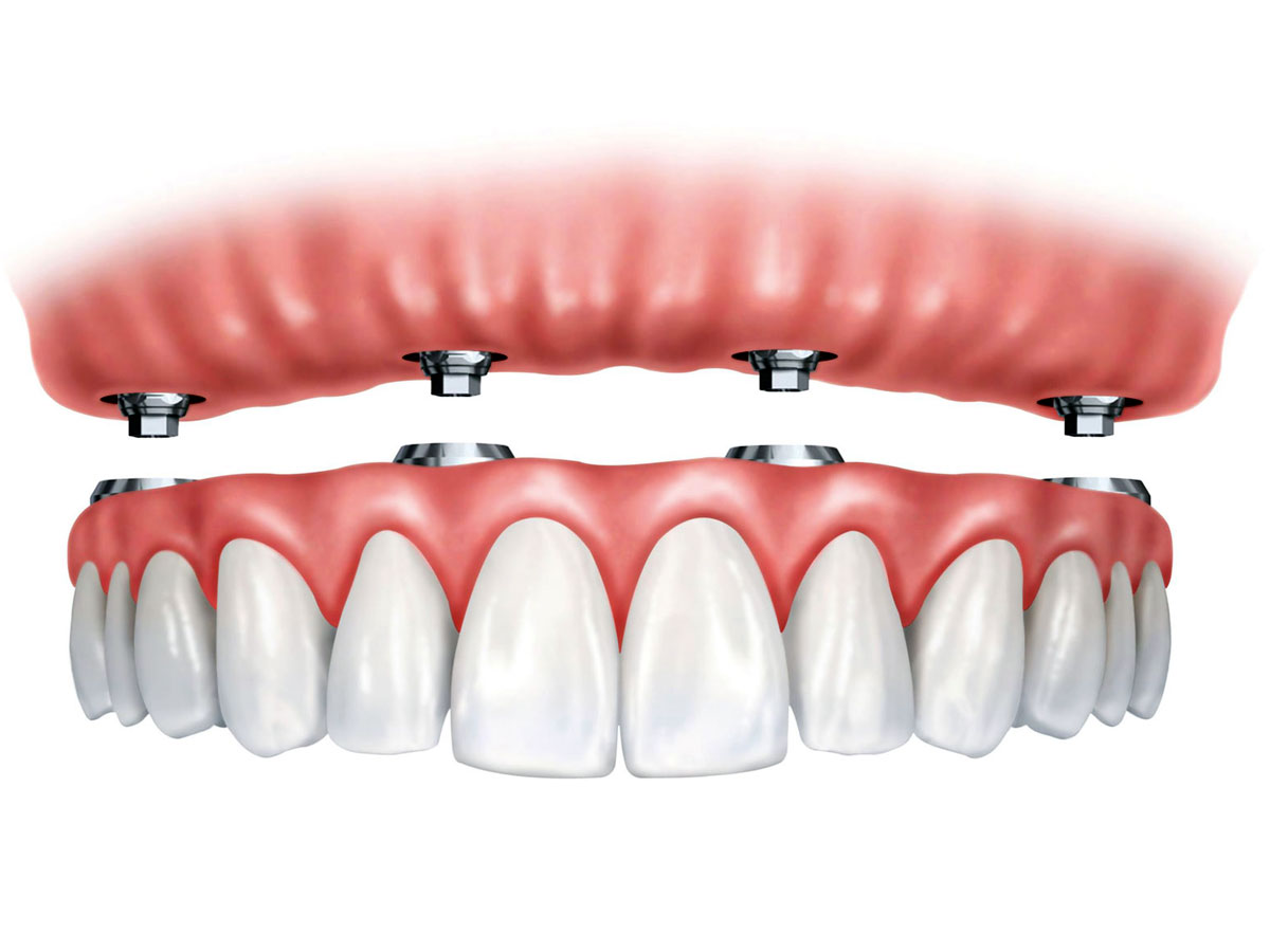 Implantes de carga inmediata o «dientes  en un solo día»