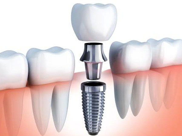 Prótesis Dental Fija Implante | Ustrell&García Clínica Dental