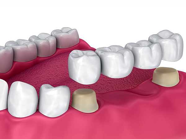 Prótesis Dental Fija Puente | Ustrell&García Clínica Dental