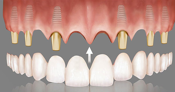 Prótesis Dental Fija Rehabilitación sobre Implantes| Ustrell&García Clínica Dental