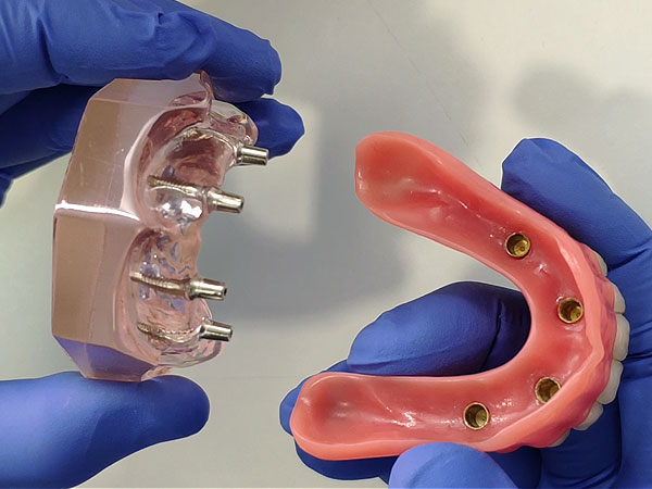 Sobredentadura - Prótesis Dental Fija | Ustrell&García Clínica Dental