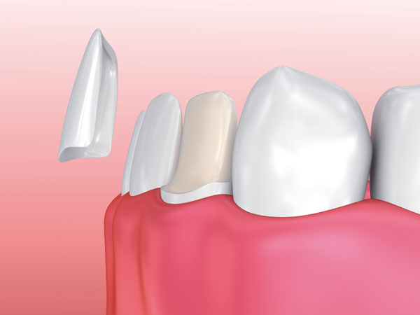 Carillas Dentales | Ustrell&García Clínica Dental