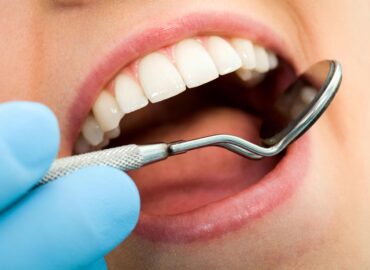 Mitos y realidades sobre el blanqueamiento dental