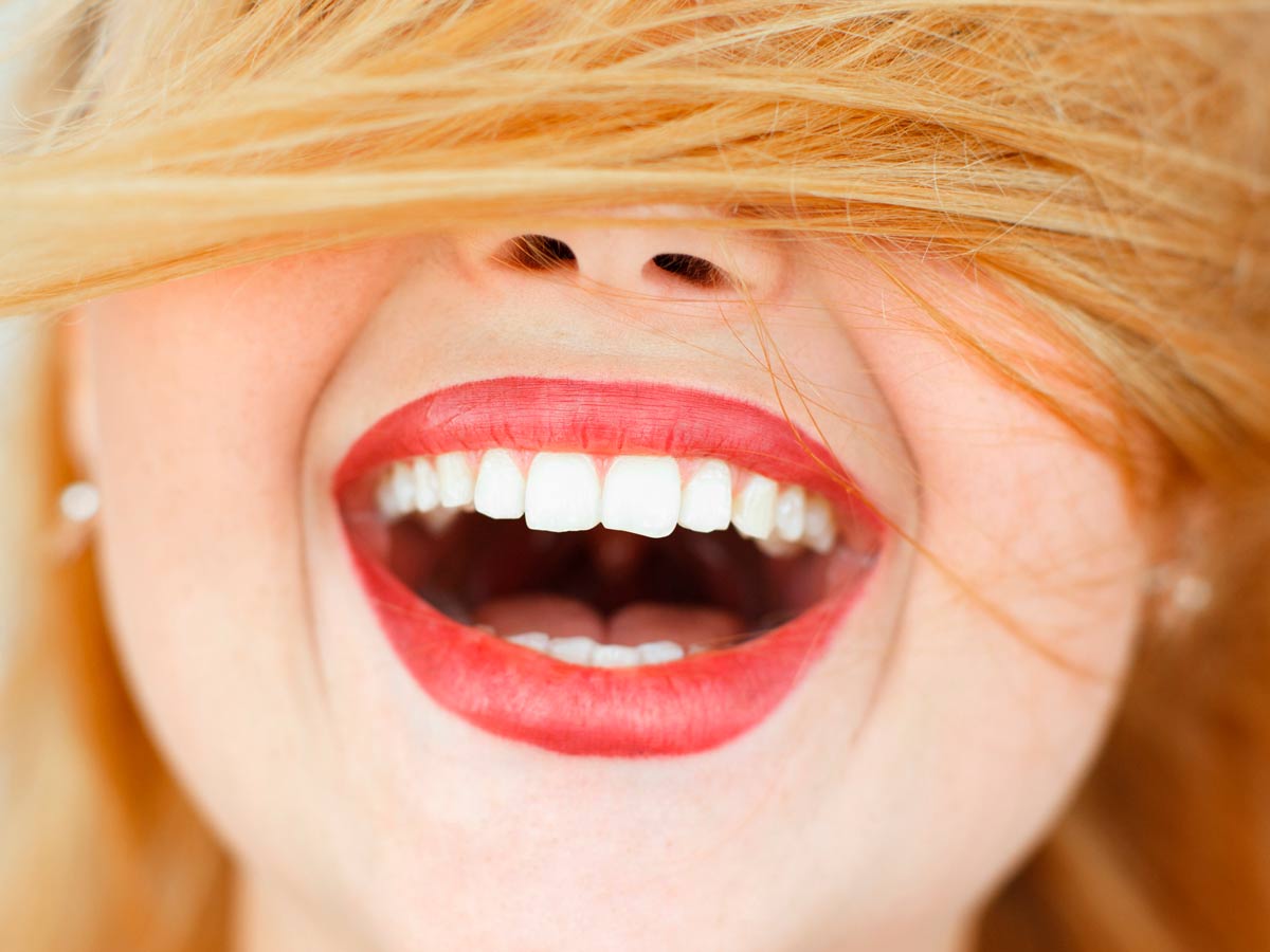 Carillas dentales. Tipos, ventajas e inconvenientes