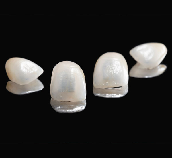 Tipos de Carillas Dentales | Ustrell & García Clínica Dental