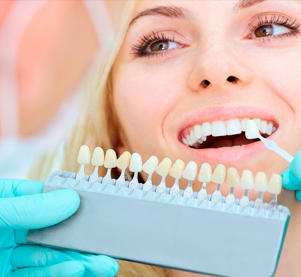 Ventajas de las Carillas Dentales | Ustrell & García Clínica Dental