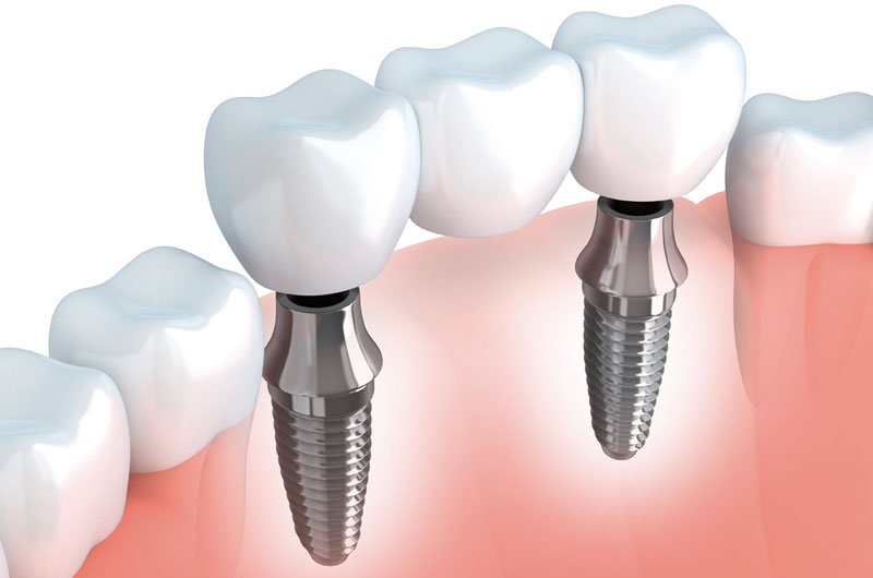 Implante Dental Colocación | Ustrell&García Clínica Dental