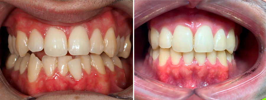 Apiñamiento Mordida en Ortodoncia | Ustrell&García Clínica Dental