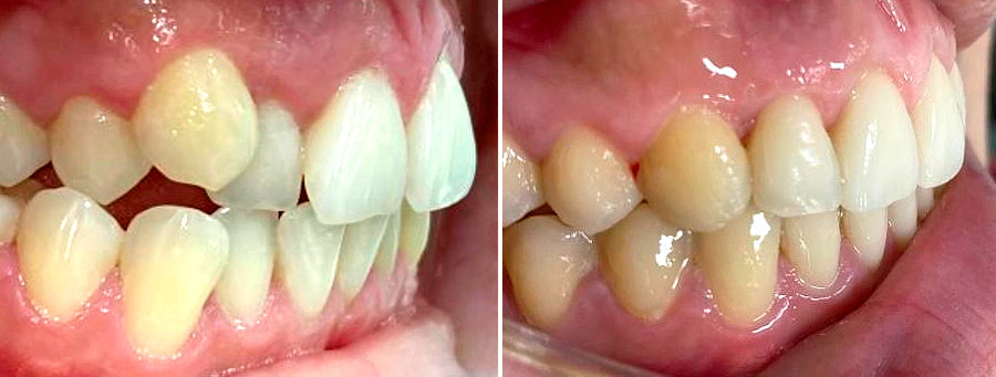 Mordida Cruzada en Ortodoncia | Ustrell&García Clínica Dental
