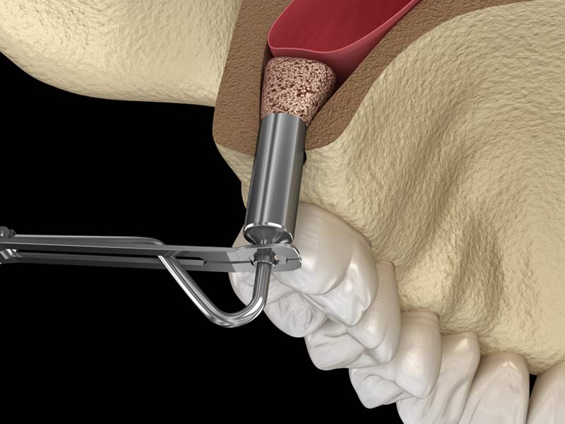 Cuándo se recomienda la cirugía de elevación de seno maxilar | Ustrell&García Clínica Dental 